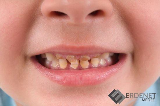 2-12 хүртэлх насны хүүхдийн шүдний эмчилгээний зардлыг ЭМД-ын сангаас гаргана